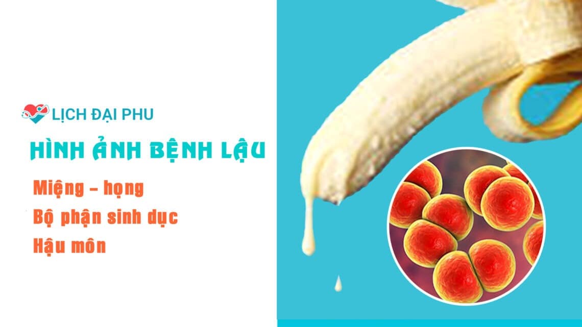 Hình ảnh bệnh lậu ở nam giới: miệng – họng, bộ phận sinh dục, hậu môn