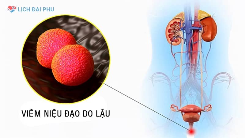 Viêm niệu đạo do lậu và viêm niệu đạo không do lậu như thế nào?