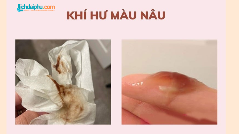 Khí hư màu nâu không mùi: Nguyên nhân, triệu chứng và cách xử lý