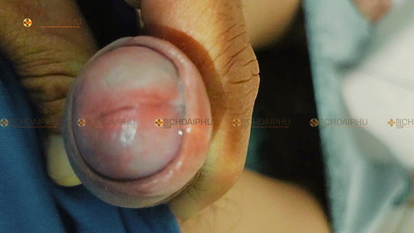 Dịch tiết mờ nhạt đầu dương vật do bệnh lậu không có triệu chứng