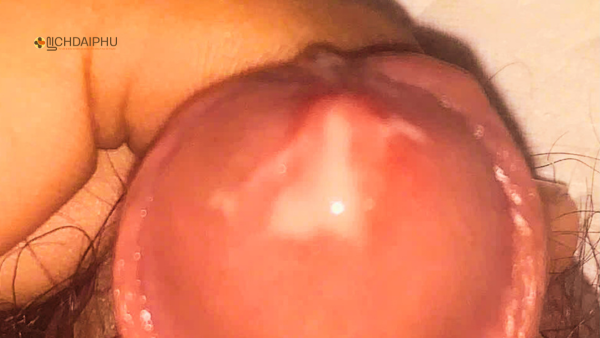 Hình ảnh dương vật chảy mủ do bệnh lậu