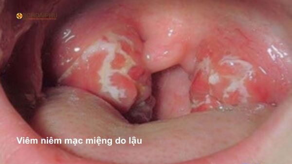 Hình ảnh vùng họng và amidan viêm loét do bệnh lậu miệng. Niêm mạc miệng bị viêm đỏ và có mủ trắng – dấu hiệu bệnh lậu miệng do quan hệ tình dục bằng miệng không an toàn.