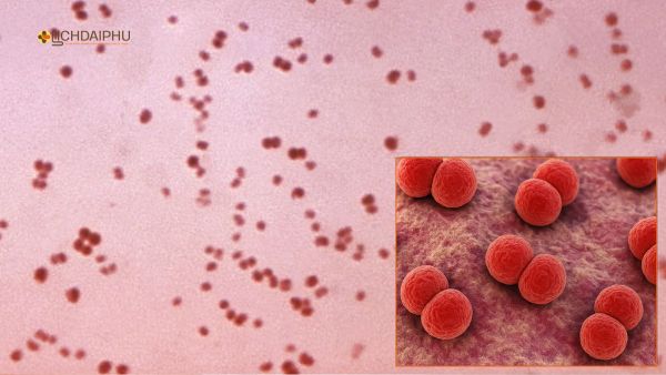 Ảnh soi tươi nhuộm Gram vi khuẩn lậu cầu Neisseria gonorrhoeae – song cầu Gram âm xếp cặp, quan sát dưới kính hiển vi. Ảnh soi tươi nhuộm Gram vi khuẩn lậu cầu Neisseria gonorrhoeae – song cầu Gram âm xếp cặp, quan sát dưới kính hiển vi.