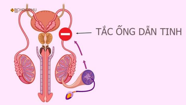 Tắc ống dẫn tinh do biến chứng bệnh lậu Hình ảnh minh họa tắc ống dẫn tinh ở nam giới do biến chứng bệnh lậu, gây cản trở đường đi của tinh trùng và dẫn đến nguy cơ vô sinh.