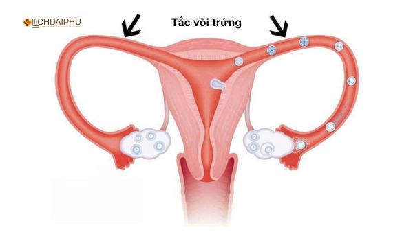 Hình ảnh minh họa tắc vòi trứng ở nữ giới do bệnh lậu, cản trở quá trình thụ tinh và tăng nguy cơ vô sinh. Hình ảnh minh họa tắc vòi trứng ở nữ giới do bệnh lậu, cản trở quá trình thụ tinh và tăng nguy cơ vô sinh.