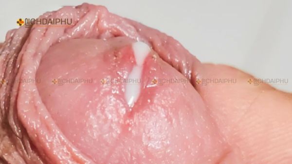 Triệu chứng bệnh lậu nam giới – chảy mủ vàng xanh ở dương vật, tiểu buốt, đau rát, sưng đỏ lỗ tiểu. Triệu chứng bệnh lậu nam giới – chảy mủ vàng xanh ở dương vật, tiểu buốt, đau rát, sưng đỏ lỗ tiểu.