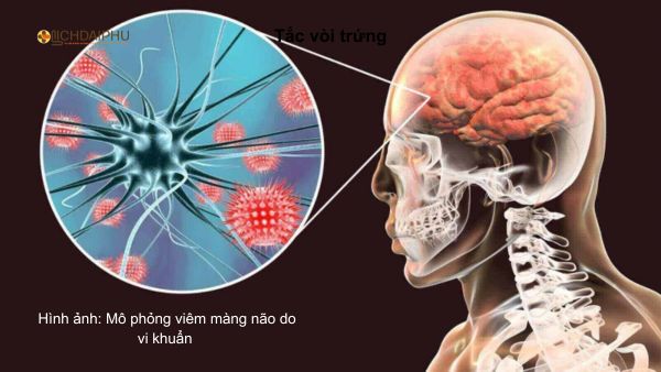 Hình ảnh minh họa viêm màng não do vi khuẩn lậu gây ra, biến chứng hiếm gặp nhưng có thể đe dọa tính mạng. Hình ảnh minh họa viêm màng não do vi khuẩn lậu gây ra, biến chứng hiếm gặp nhưng có thể đe dọa tính mạng.