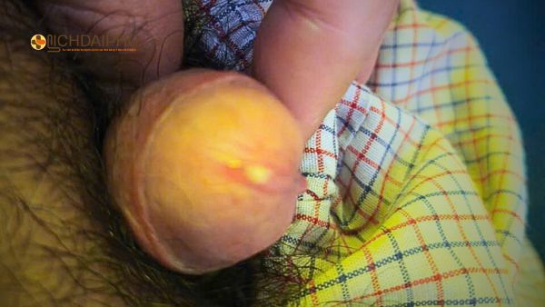 Hình ảnh triệu chứng bệnh lậu ở nam giới: Tiểu buốt, chảy mủ Hình minh họa triệu chứng bệnh lậu ở nam giới: tiểu buốt, chảy mủ, sưng đau vùng kín, cảnh báo cần điều trị sớm.