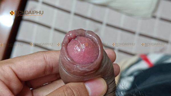 Dấu hiệu nhận biết bệnh lậu ở nam giới – Biểu hiện giai đoạn đầu cần chú ý Hình ảnh dấu hiệu bệnh lậu ở nam giới, xuất hiện dịch mủ và sưng đỏ vùng quy đầu – triệu chứng điển hình của bệnh lậu giai đoạn sớm.