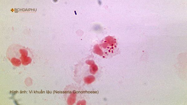 Hình ảnh song cầu khuẩn lậu (Neisseria Gonorrhoeae) – Vi khuẩn gây bệnh lậu được quan sát dưới kính hiển vi nhuộm Gram. Hình ảnh hiển vi song cầu khuẩn lậu (Neisseria Gonorrhoeae) trong mẫu bệnh phẩm, vi khuẩn có dạng hạt cà phê nằm trong bạch cầu, đặc trưng của bệnh lậu.