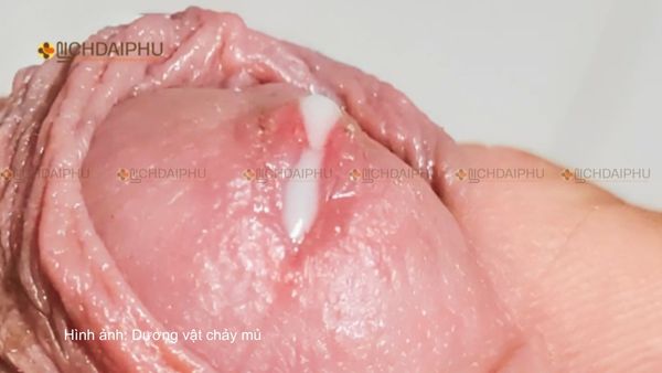 Triệu chứng bệnh lậu ở nam giới như chảy mủ dương vật, tiểu buốt, sưng đỏ niệu đạo.