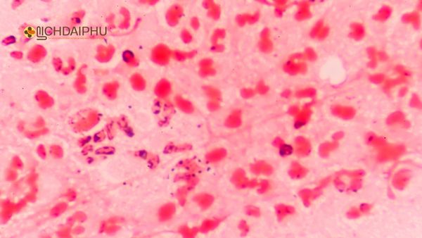 Vi khuẩn lậu Neisseria gonorrhoeae dưới kính hiển vi – Tác nhân gây bệnh lậu Hình ảnh vi khuẩn lậu Neisseria gonorrhoeae dưới kính hiển vi, tác nhân gây bệnh lậu lây qua đường tình dục.