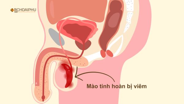 Biến chứng viêm mào tinh hoàn ở nam giới – Cảnh báo nguy cơ vô sinh nếu không điều trị sớm Hình minh họa viêm mào tinh hoàn ở nam giới do biến chứng bệnh lậu, biểu hiện sưng đau vùng bìu, nguy cơ vô sinh cao.